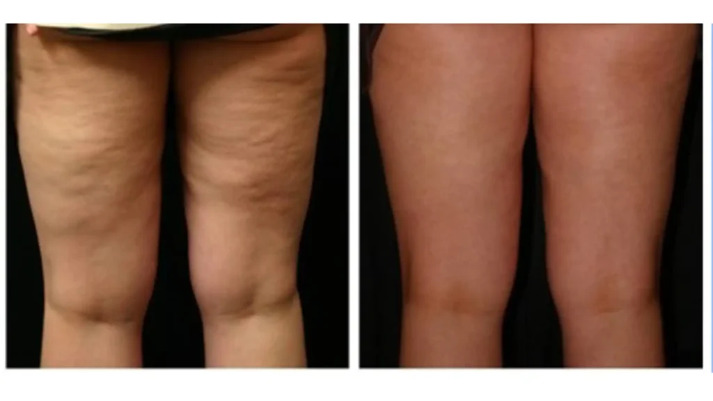 سلولیت چیست؟درمان خانگی، ورزشی و کلینیکی سلولیت چیست؟درمان خانگی، ورزشی و کلینیکی