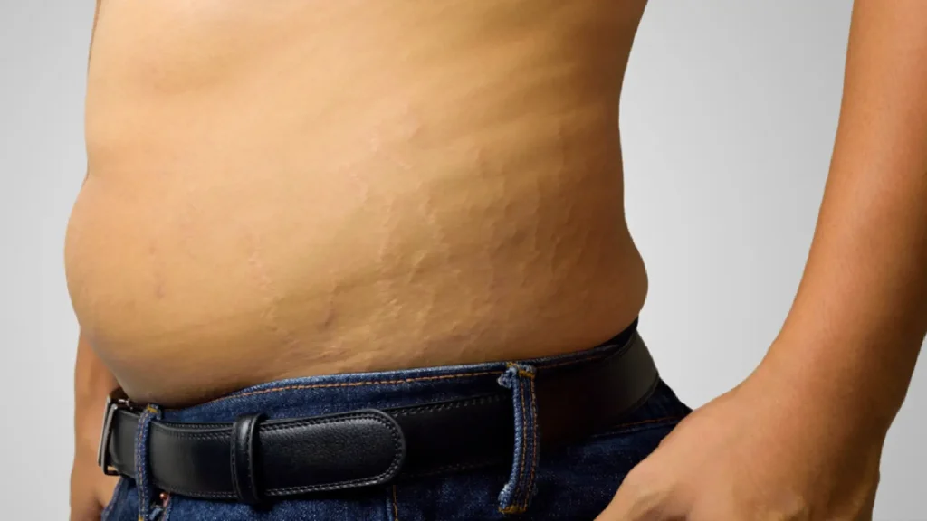 سلولیت چیست؟درمان خانگی، ورزشی و کلینیکی